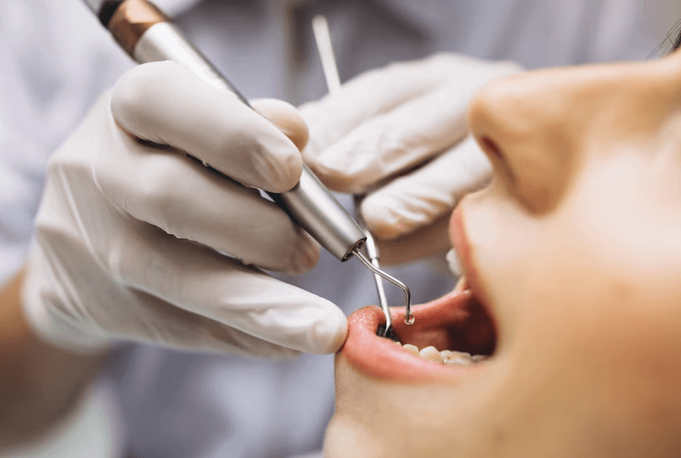 precio-de-endodoncia-cuauhtemoc-cdmx