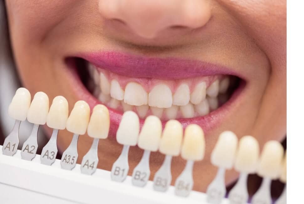 precio-de-coronas-dentales-clinica-altata-cuauhtemoc-cdmx